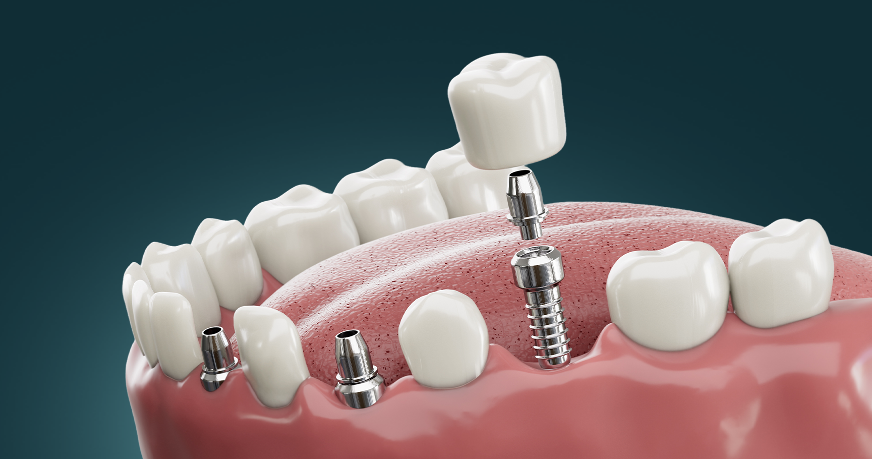 Dental Implants