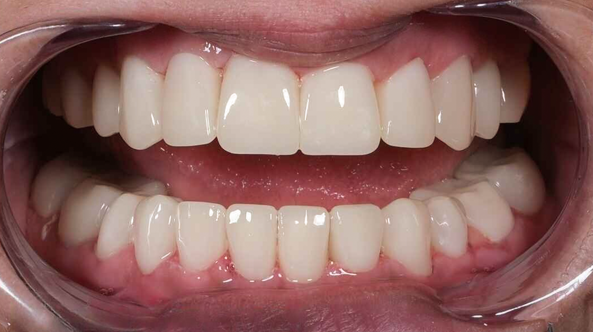 After treatment