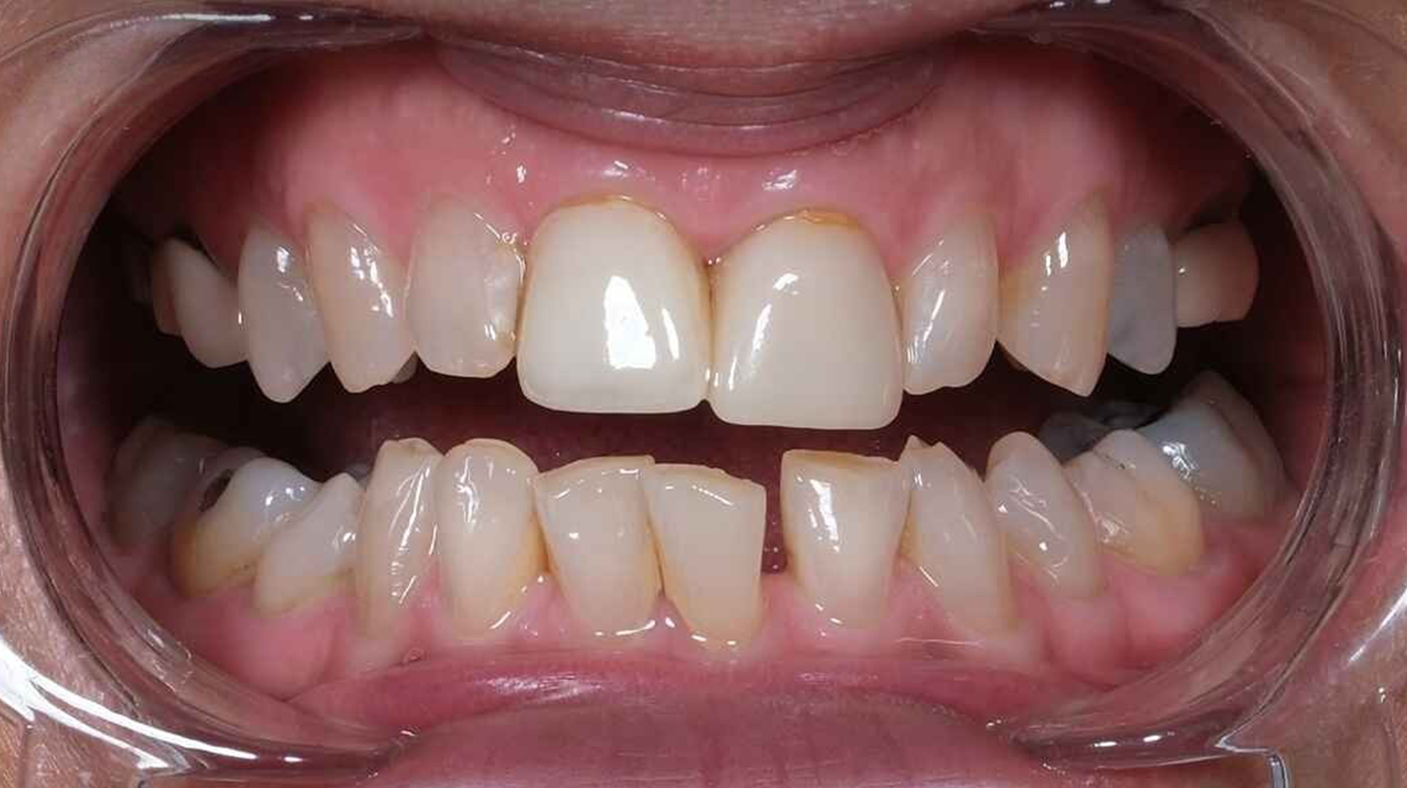 Before treatment