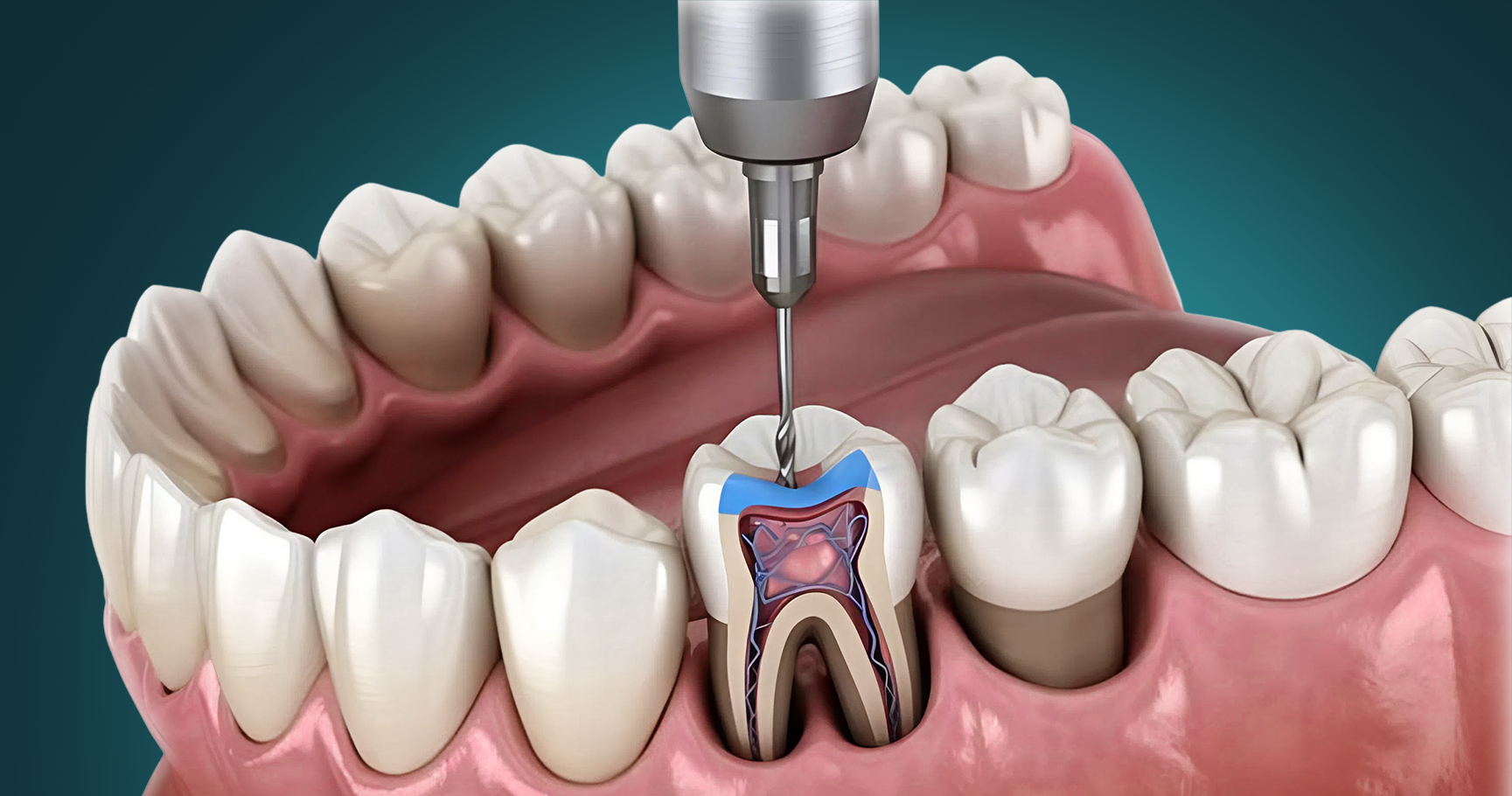 Root Canal Treatment