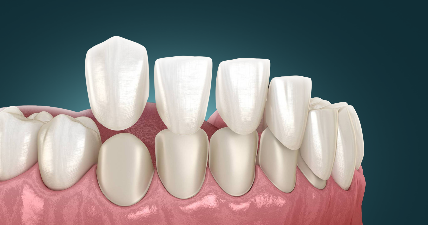 Veneers and Crowns