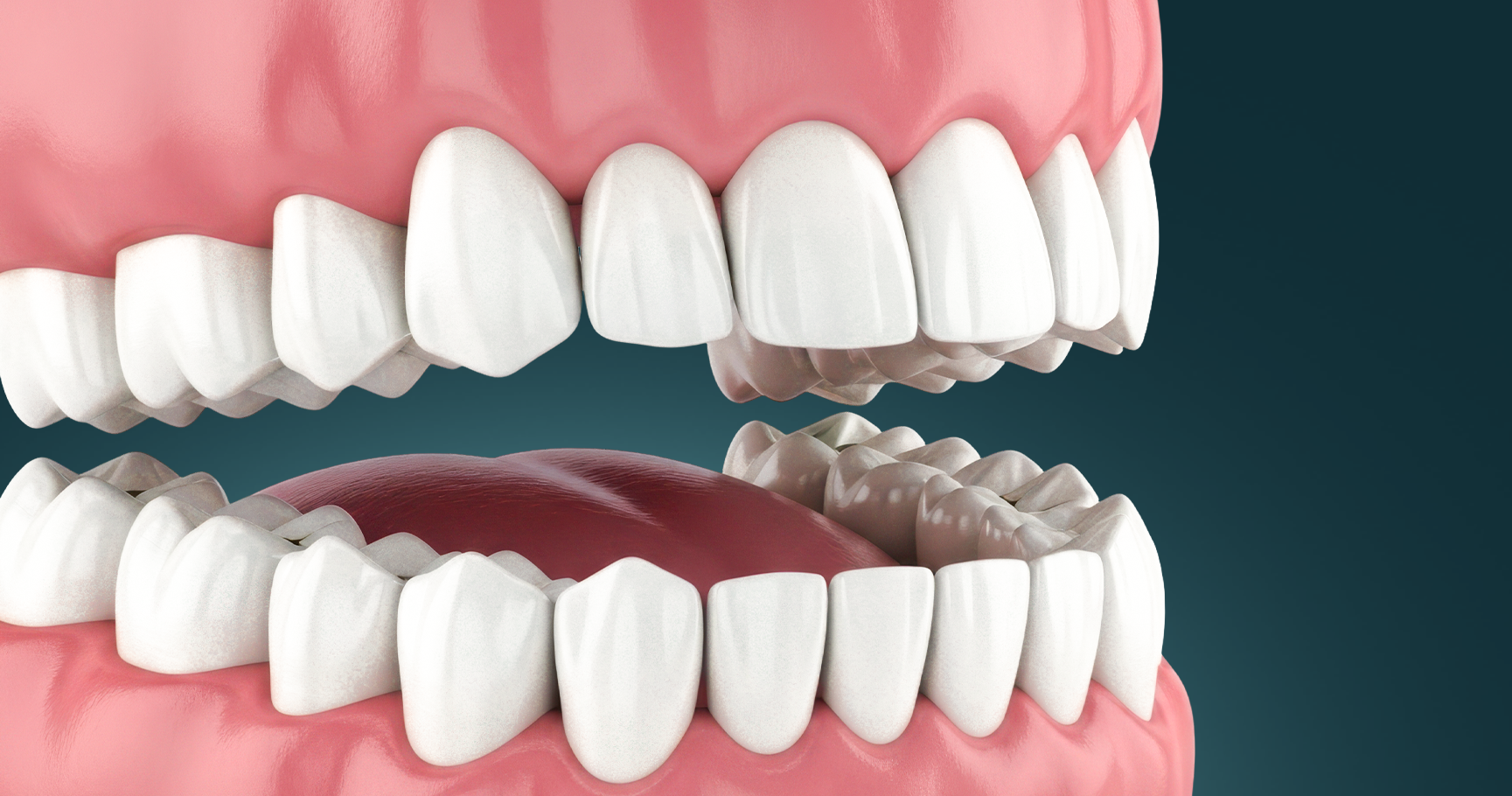 Teeth Whitening
