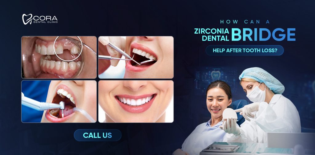 Cora Dental Zirconia dental bridge treatment after tooth loss