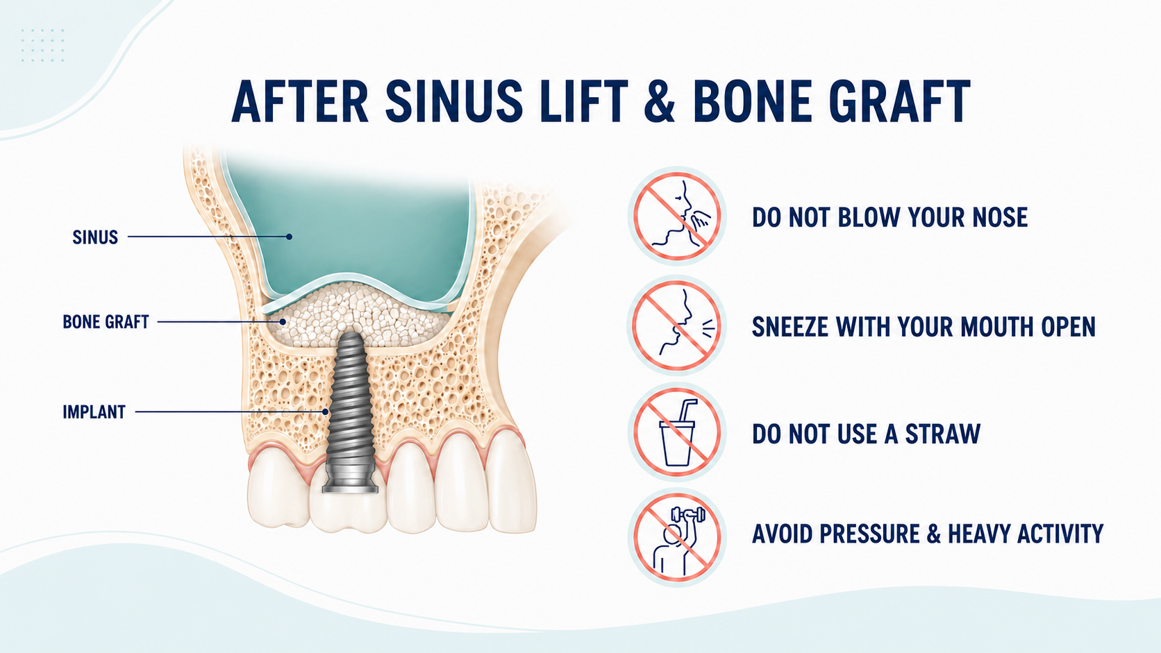 Aftercare instructions following sinus lift and bone graft surgery