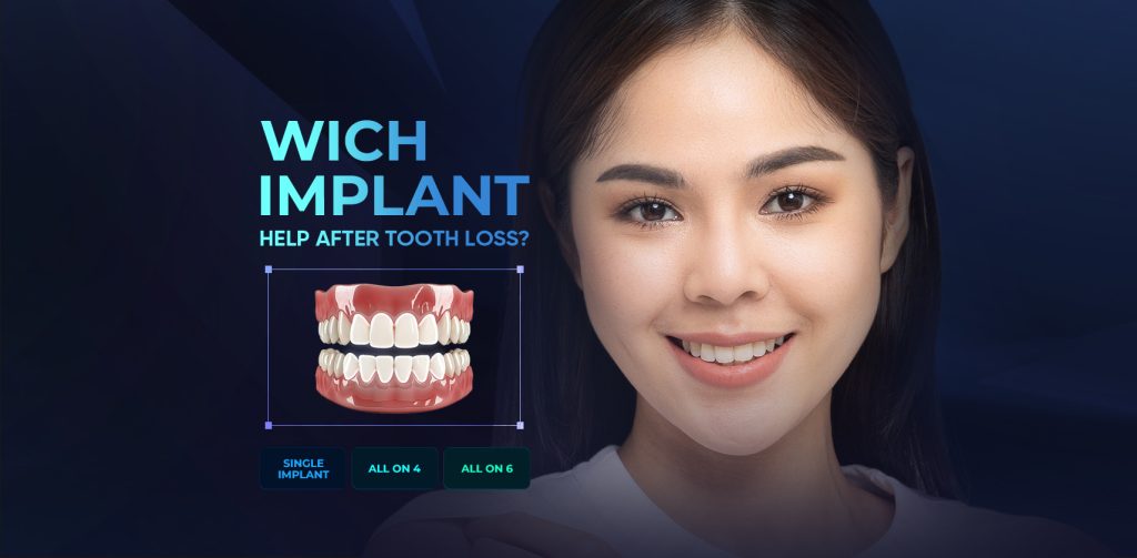 Dental implant options: single implant, All-on-4 and All-on-6 at Cora Dental