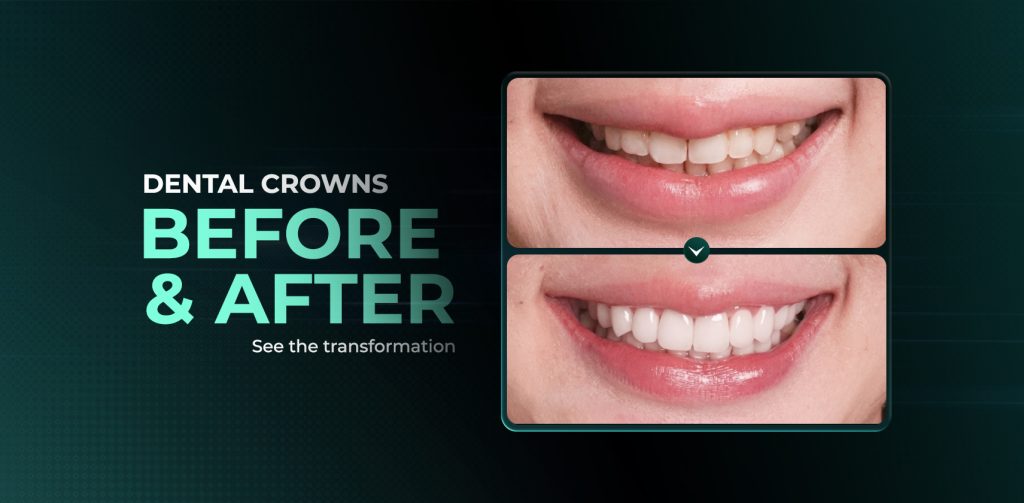 Dental crowns before and after at Cora Dental Clinic