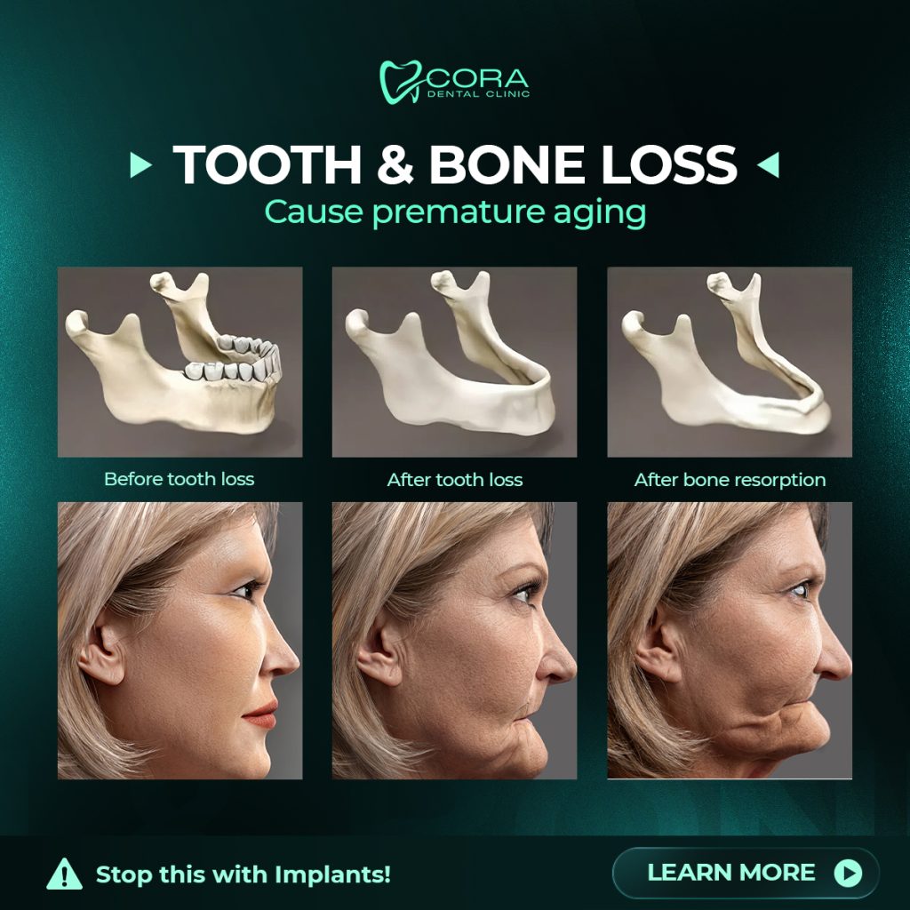 Tooth and bone changes that may occur after tooth loss
