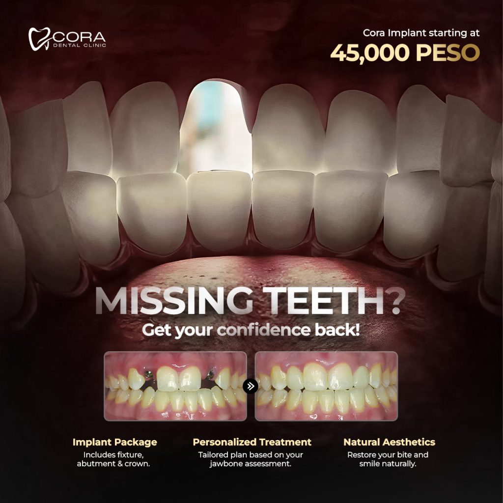 Before and after dental implant restoration for a missing tooth at Cora Dental
